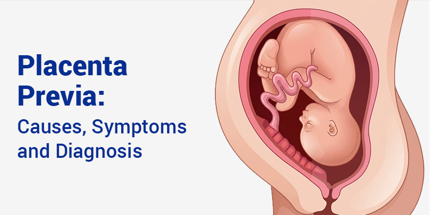 Placenta Previa: Causes, Symptoms and Diagnosis